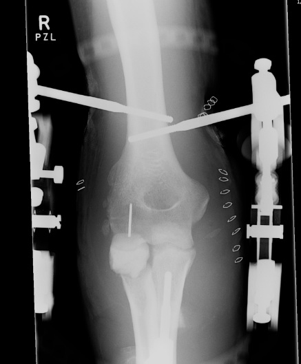 Compass Hinge AP Xray